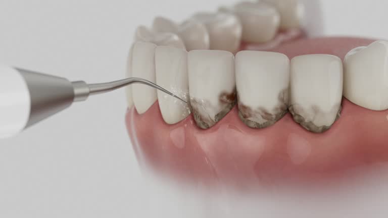 Trusted Dental Crowns And Bridges service in Castle Rock, CO - Dentist Open Now